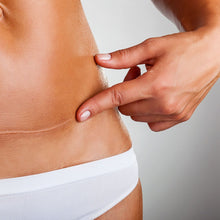 Load image into Gallery viewer, Advanced Skincare Sheets for C-sections, Keloids and Hypertrophic Scars